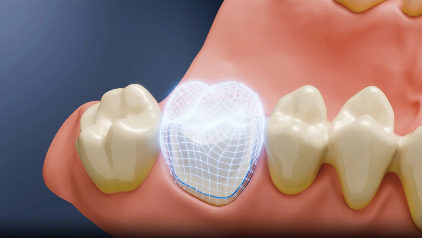 Aoralscan Elf - AI tervezés