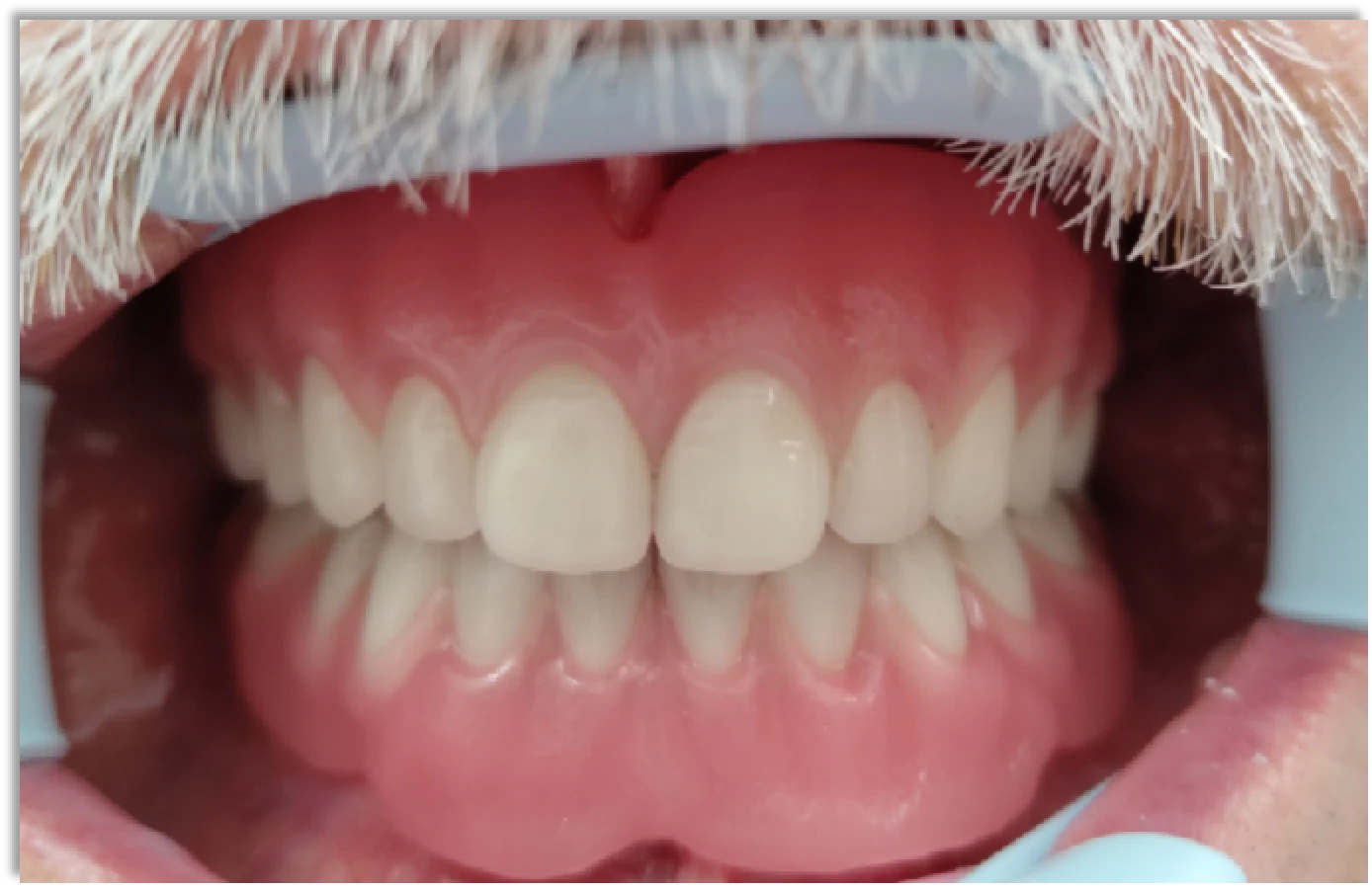 Mart és 3D nyomtatott fogsoralap összehasonlítása