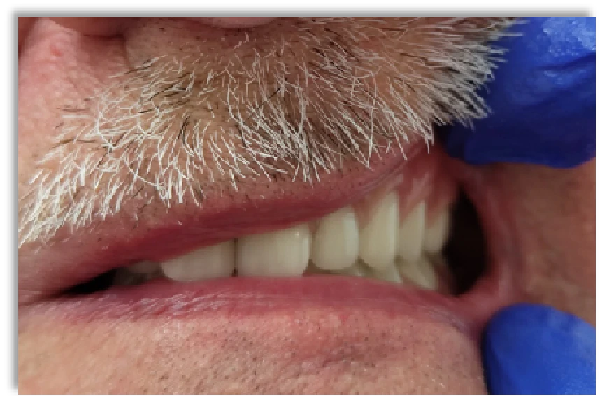 Mart és 3D nyomtatott fogsoralap összehasonlítása