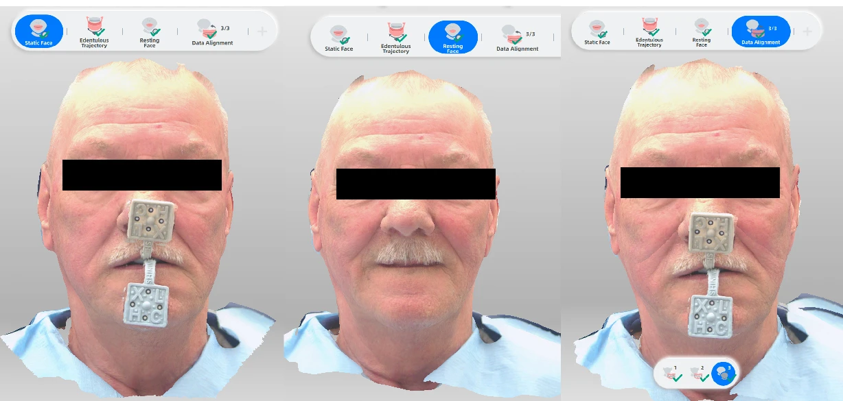 Statikus arcrögzítés