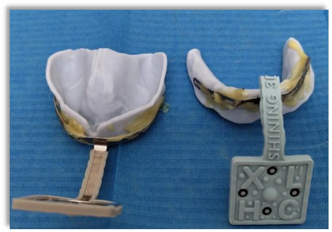 Egyedi tálca szájon kívüli szkennelése Jaw Motion Tracker segítségével