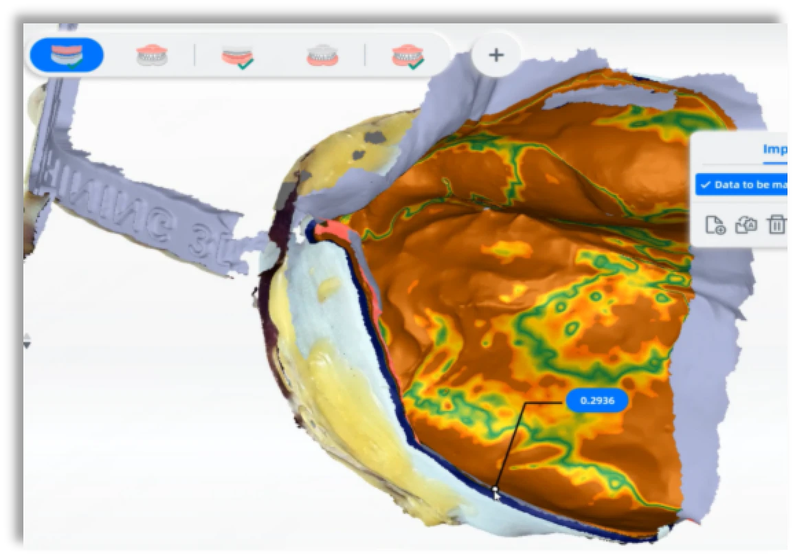 Egyedi tálca szájon kívüli szkennelése Jaw Motion Tracker segítségével