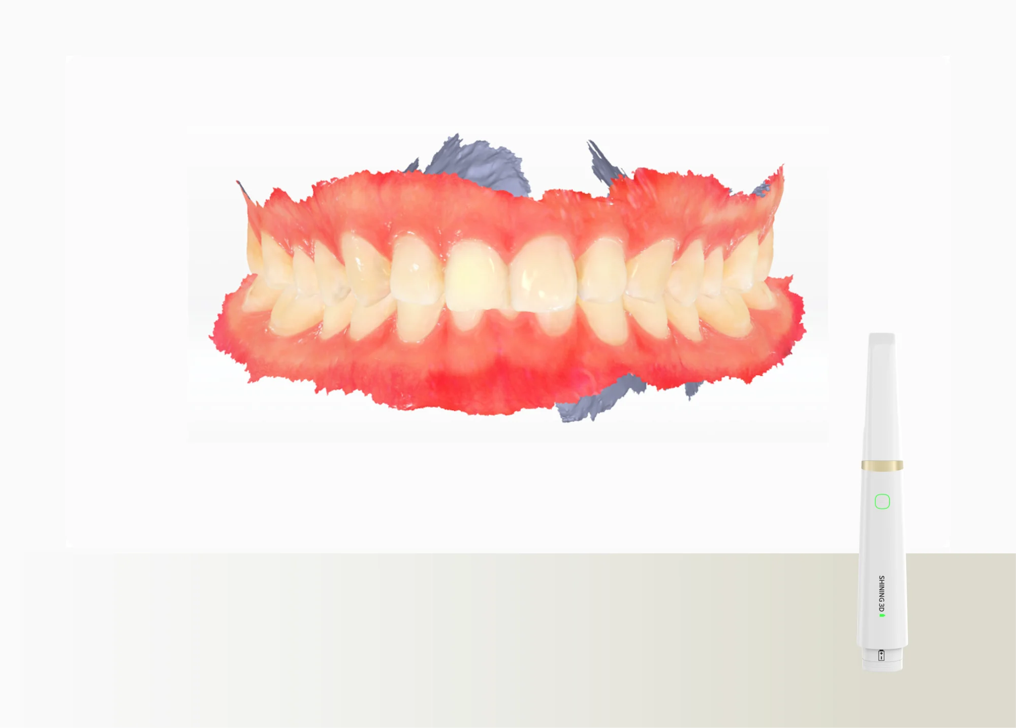 Intraorális szkenner normál esetekhez